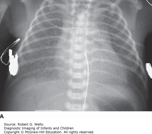 Neonatal Lung Disease | Obgyn Key