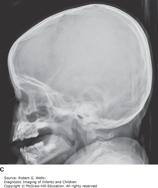 Skeletal Dysplasias | Obgyn Key