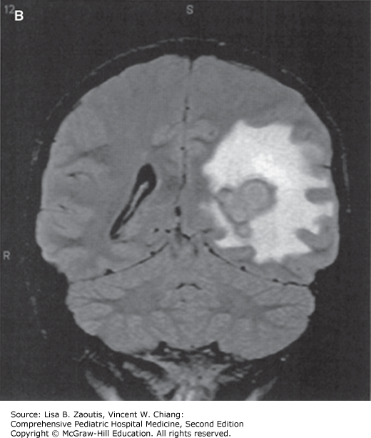 Central Nervous System Infections | Obgyn Key