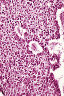 Neuroendocrine Carcinoma, Mixed Epithelial/Mesenchymal And Mesenchymal ...