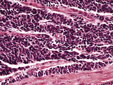 Neuroendocrine Carcinoma, Mixed Epithelial/Mesenchymal And Mesenchymal ...