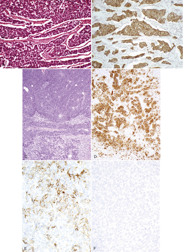 Neuroendocrine Carcinoma, Mixed Epithelial/Mesenchymal And Mesenchymal ...