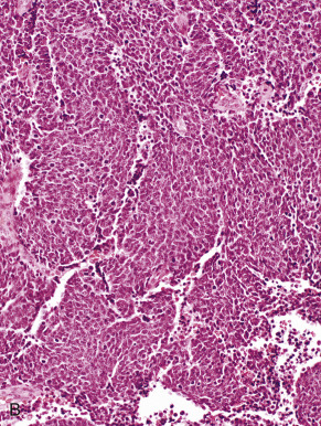 Neuroendocrine Carcinoma, Mixed Epithelial/Mesenchymal And Mesenchymal ...