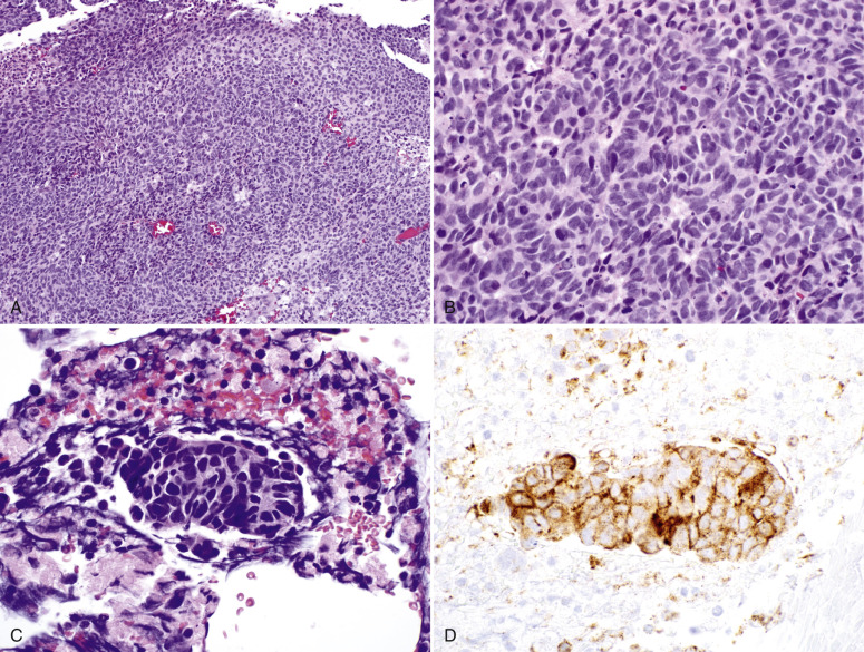 Neuroendocrine Carcinoma, Mixed Epithelial/Mesenchymal And Mesenchymal ...