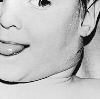 Cervical Lymphadenitis Obgyn Key