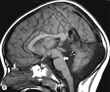 Malformation Syndromes | Obgyn Key