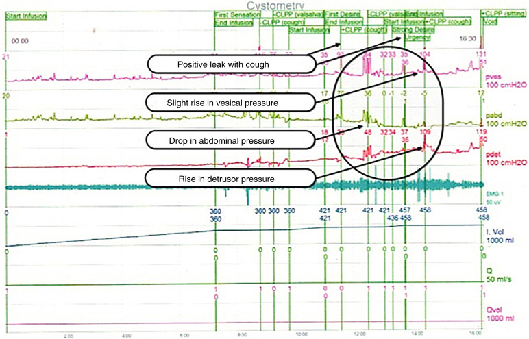 Urodynamics: Indications, Techniques, Interpretation, And Clinical ...