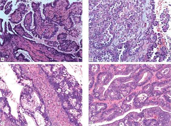 Epithelial Ovarian Cancers: Low Malignant Potential And Non-Serous ...