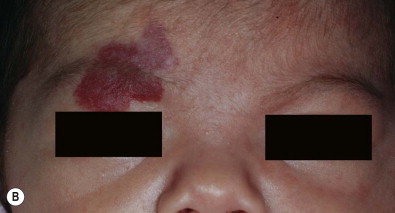 Infantile Hemangiomas And Other Vascular Tumors | Obgyn Key