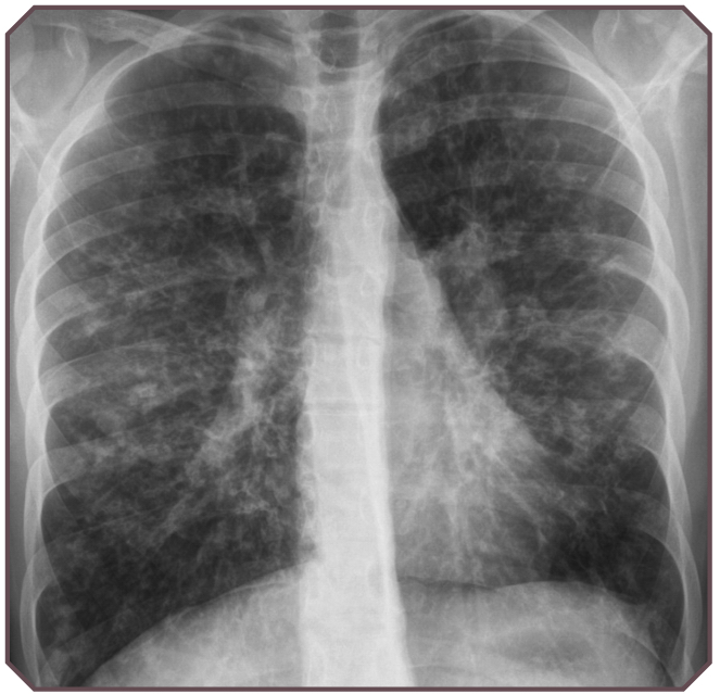 Nontuberculous Mycobacterial Pulmonary Disease | Obgyn Key