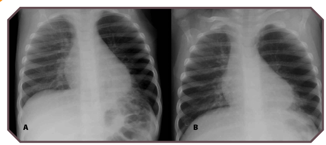 Pulmonary Aspiration: Foreign Bodies And Massive Aspiration | Obgyn Key