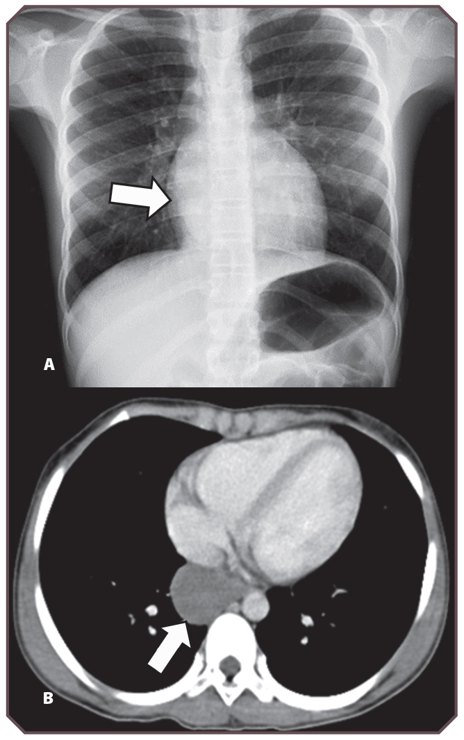 Thoracic Tumors | Obgyn Key