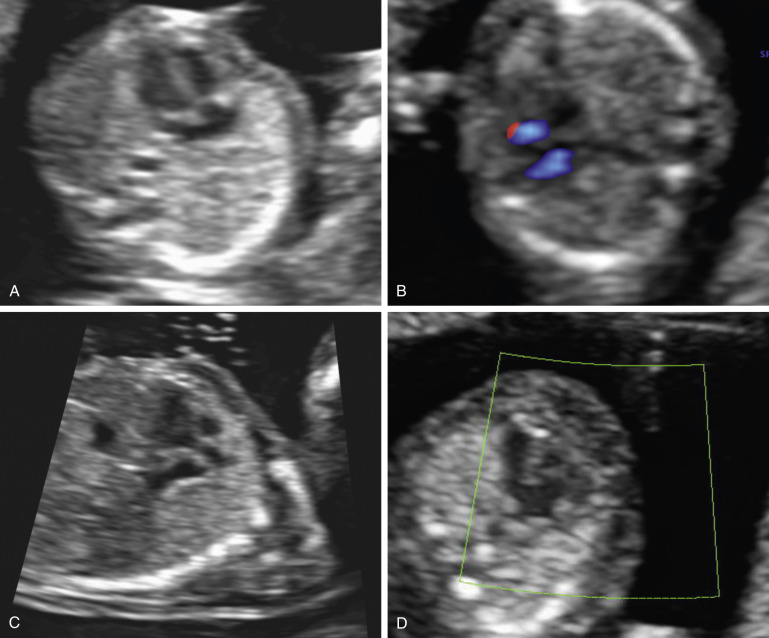 Evaluation Of Fetal Anatomy In The First Trimester | Obgyn Key