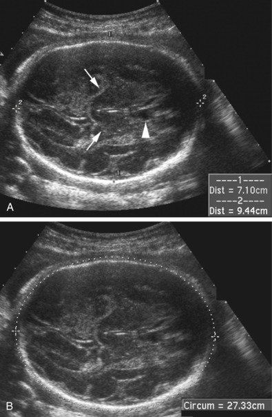 Fetal Biometry And Growth | Obgyn Key