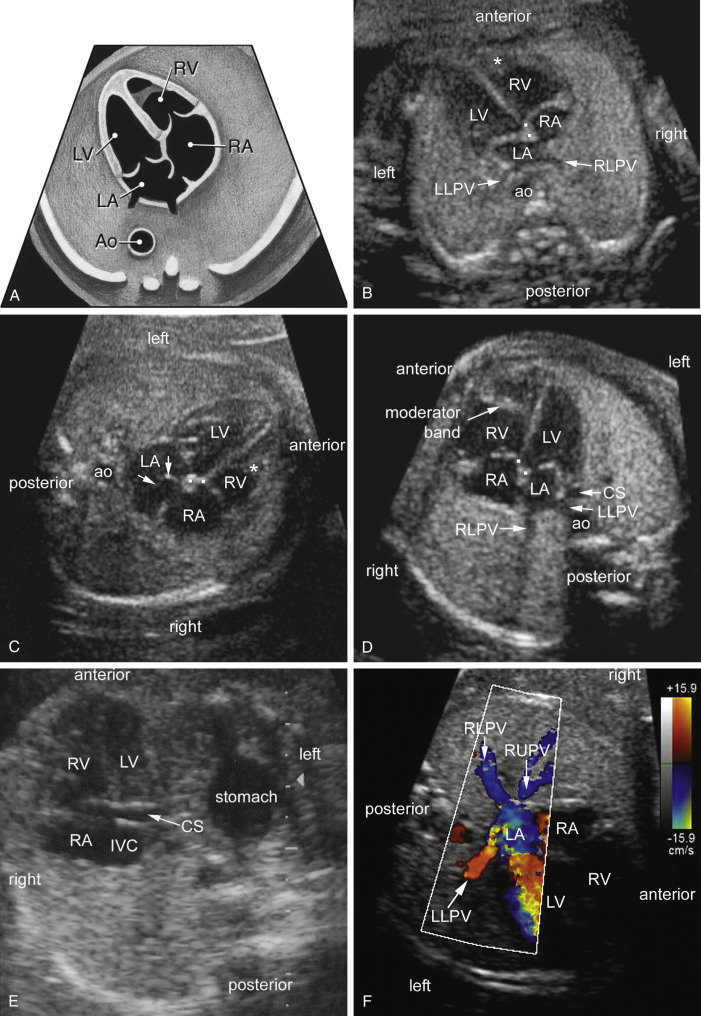 Sonographic Evaluation Of The Fetal Heart | Obgyn Key