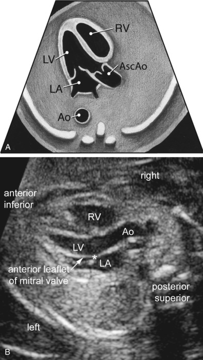 Sonographic Evaluation Of The Fetal Heart | Obgyn Key