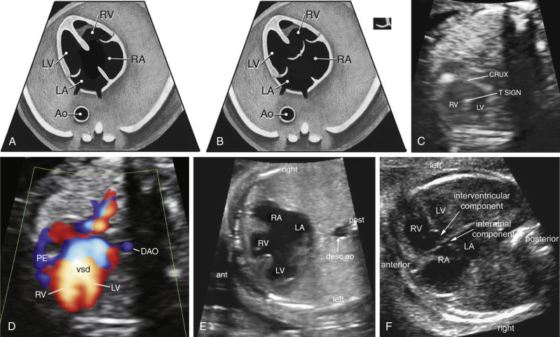 Sonographic Evaluation Of The Fetal Heart | Obgyn Key