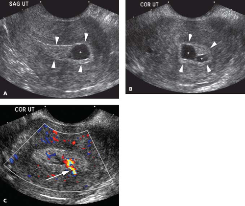 Endometrium | Obgyn Key