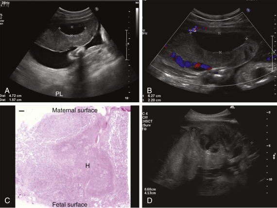 Placental Pathology And Implications For Fetal Medicine | Obgyn Key