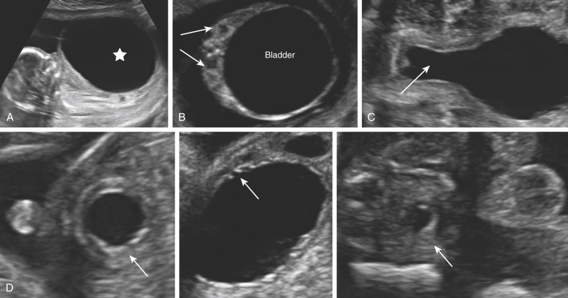 Kidney And Urinary Tract Disorders | Obgyn Key