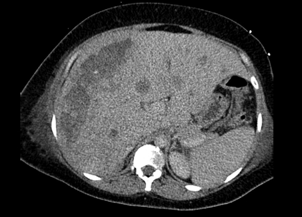 Gestational Trophoblast Neoplasia | Obgyn Key