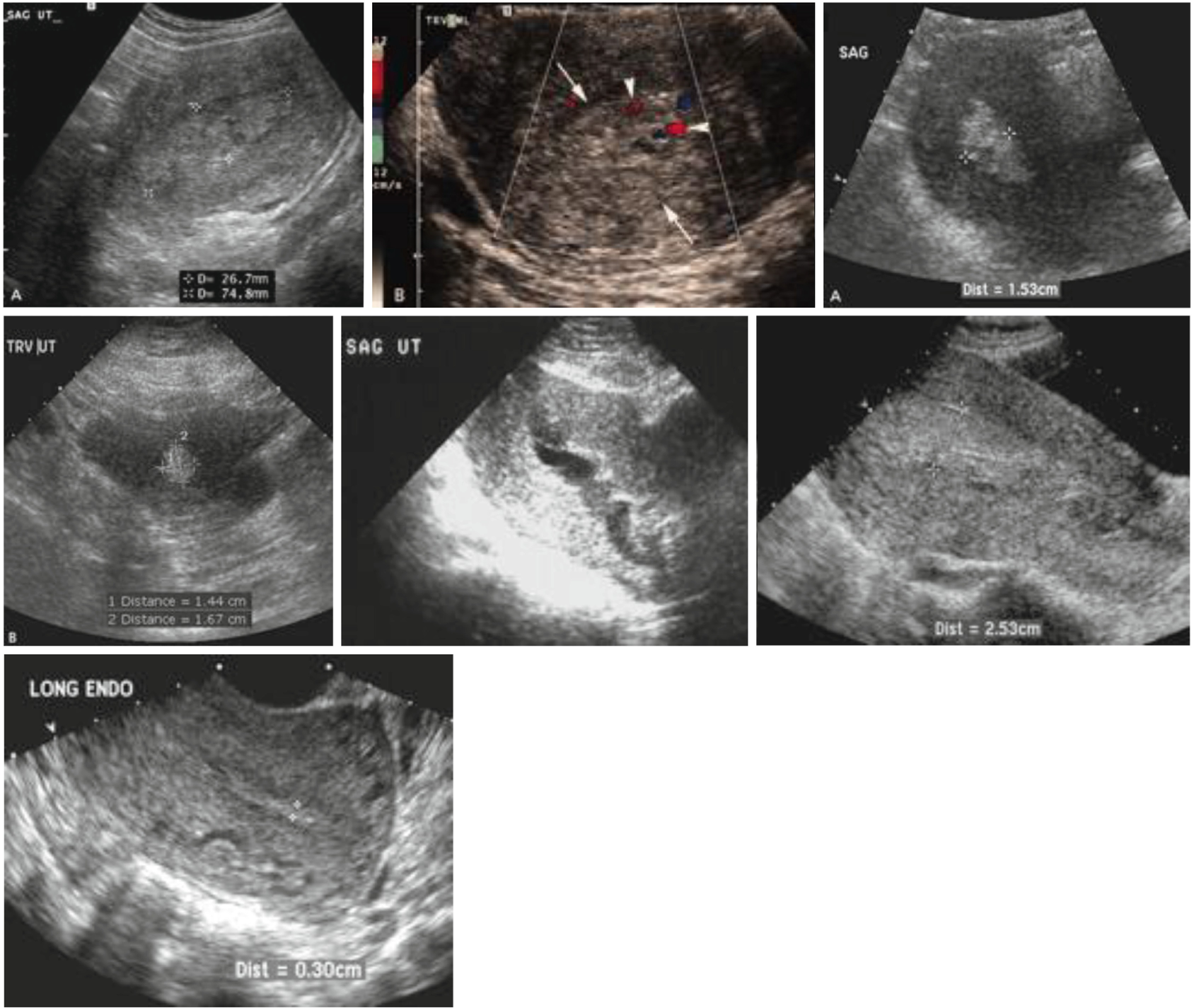 Retained Placenta | Obgyn Key