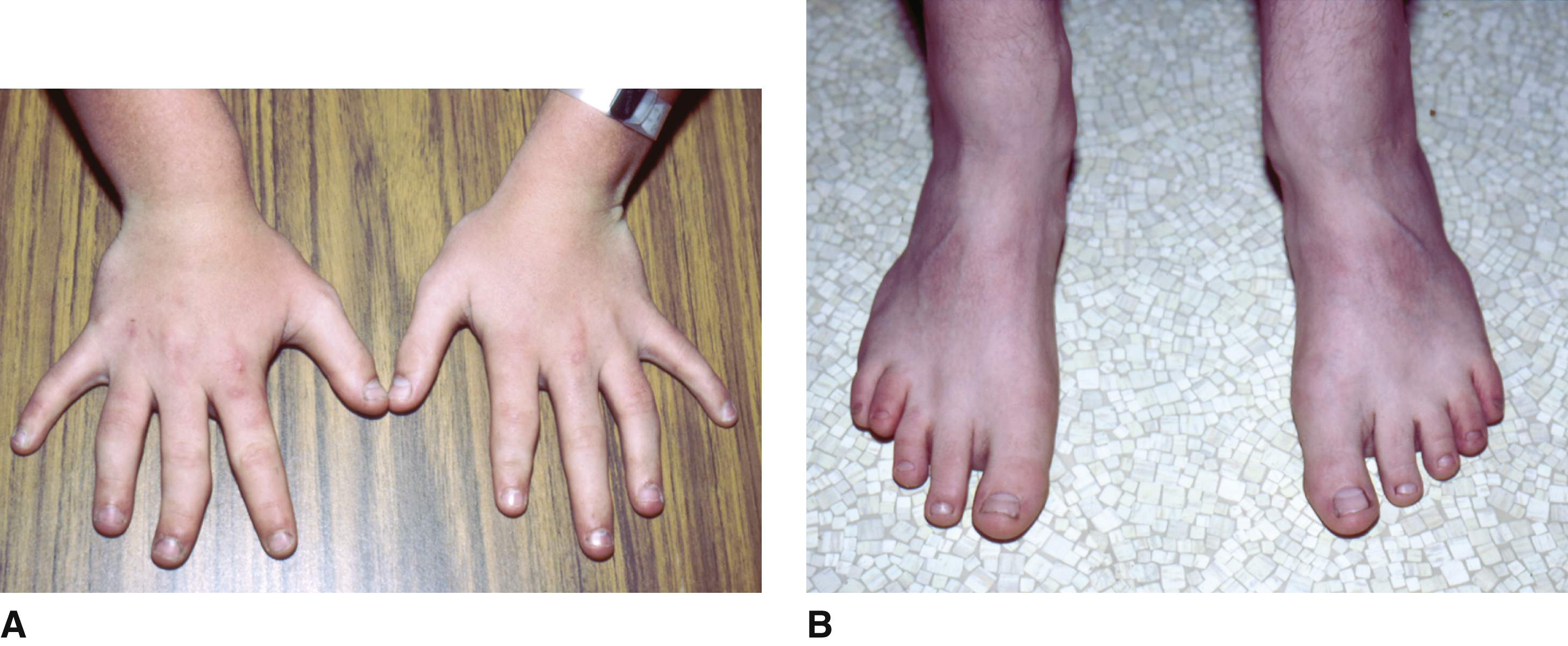 Other Skeletal Dysplasias | Obgyn Key