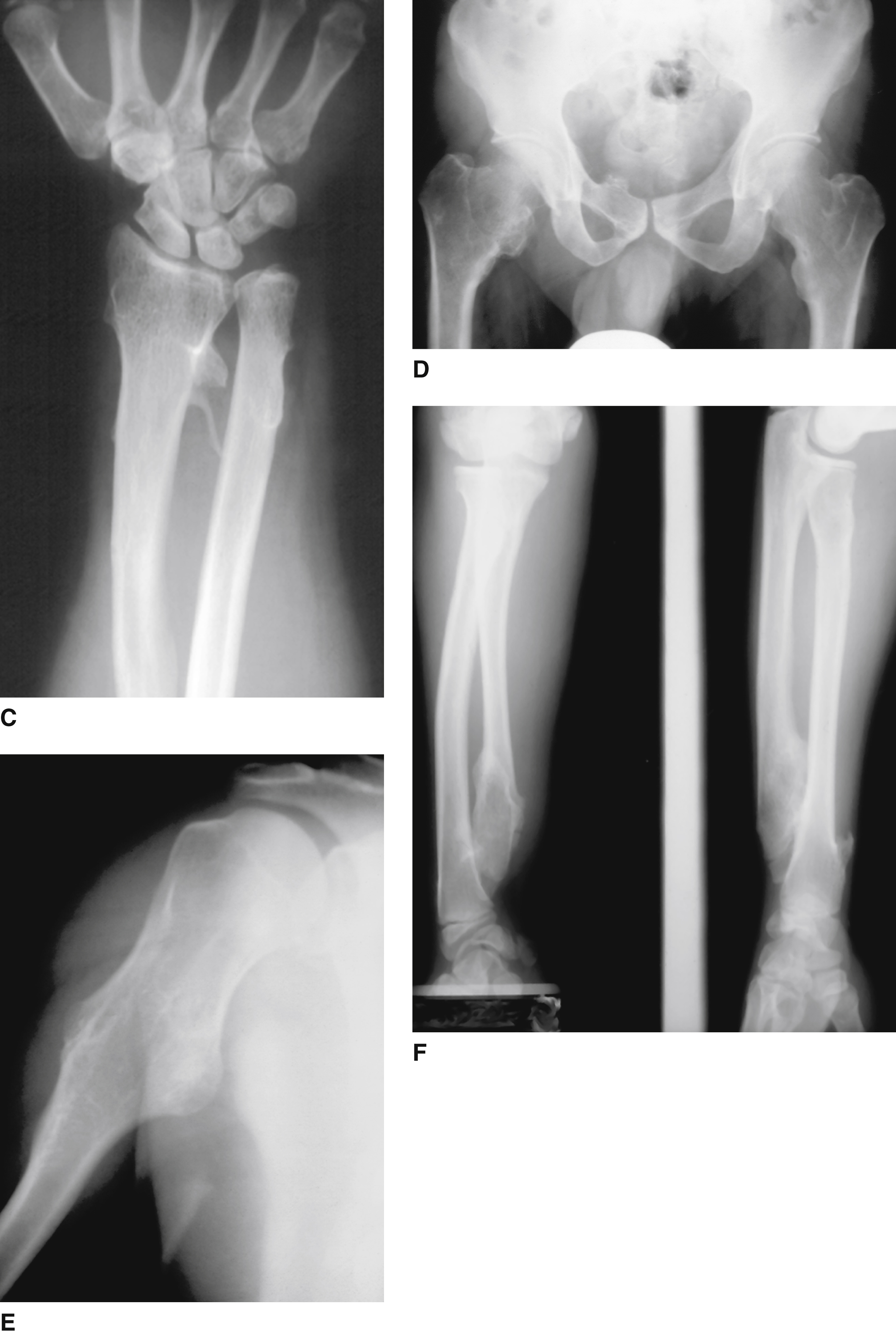 Other Skeletal Dysplasias | Obgyn Key