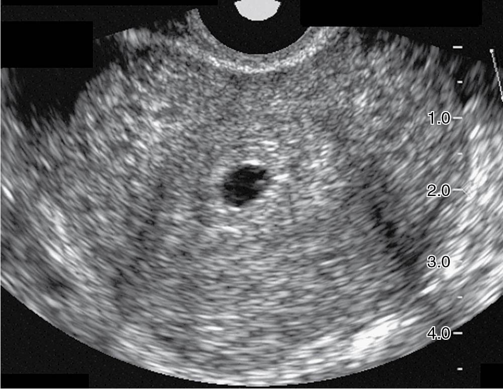 Early And Recurrent Pregnancy Loss: Etiology, Diagnosis, Treatment ...