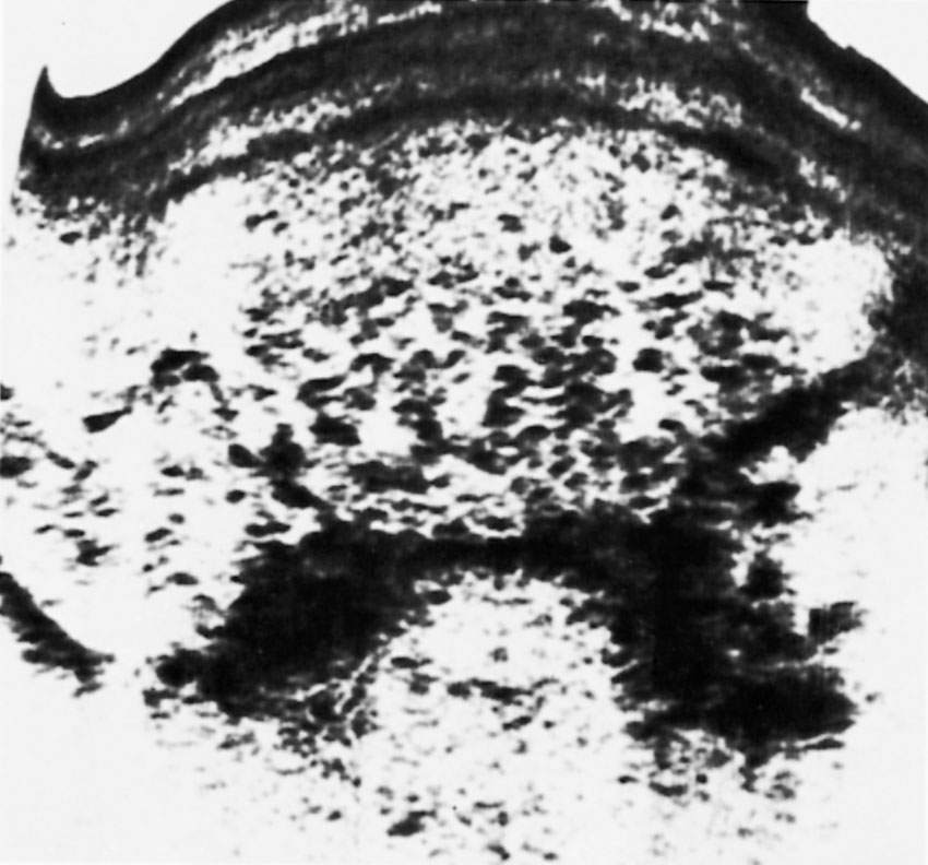 Gestational Trophoblastic Disease: Hydatidiform Mole, Nonmetastatic And ...