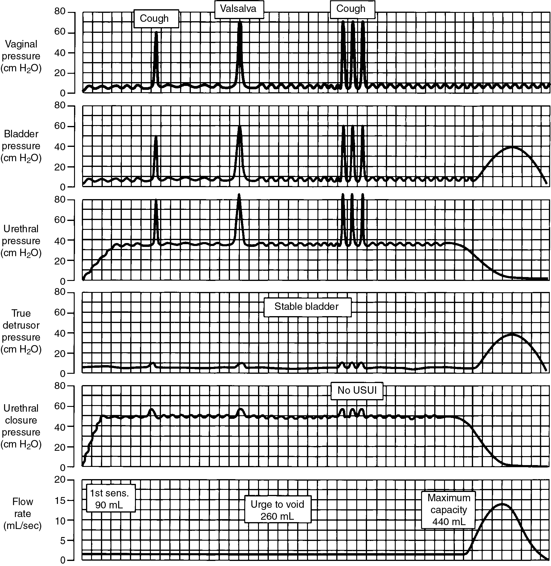 Urodynamics: Indications, Techniques, Interpretation, And Clinical ...