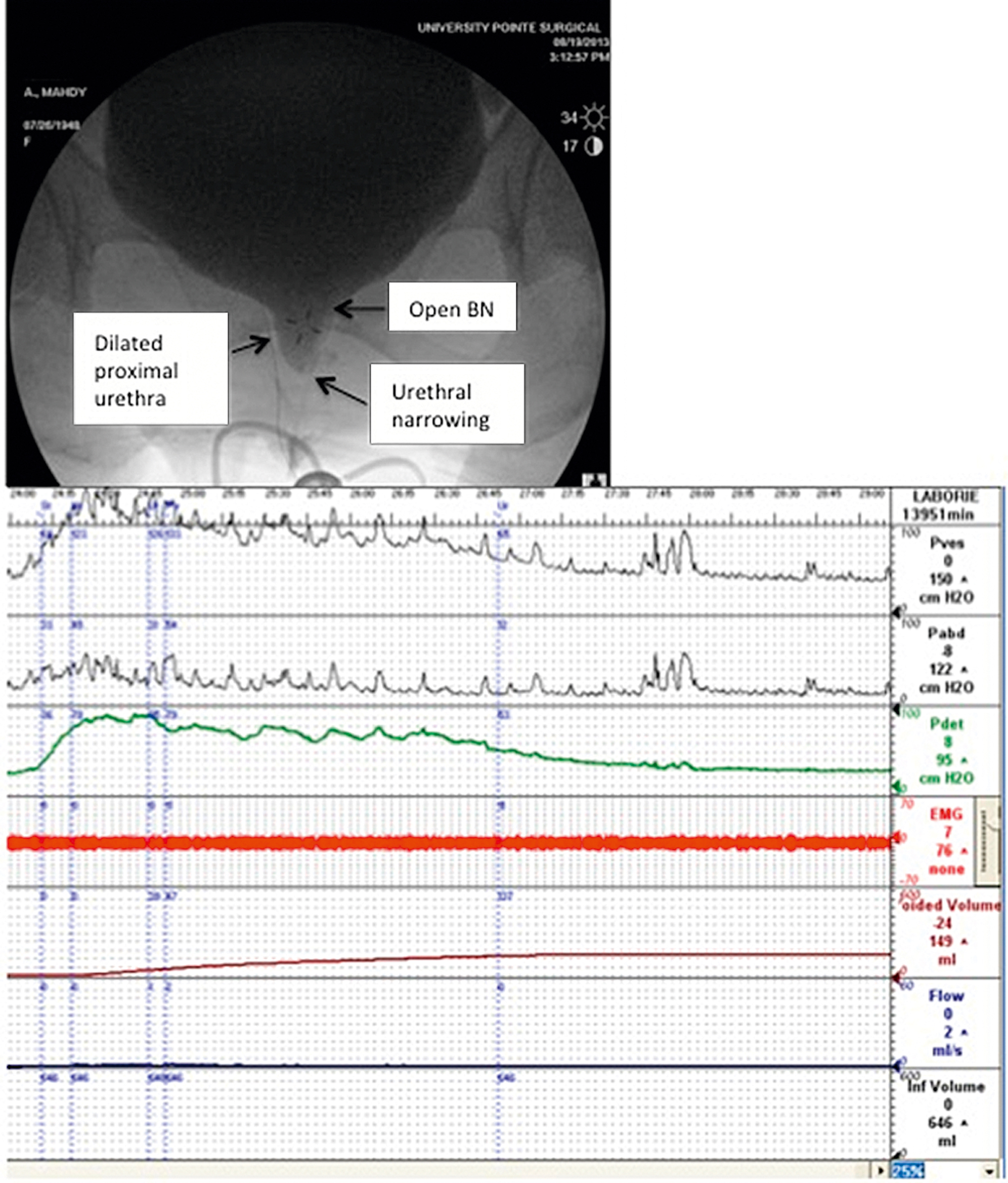 Urodynamics: Indications, Techniques, Interpretation, And Clinical ...