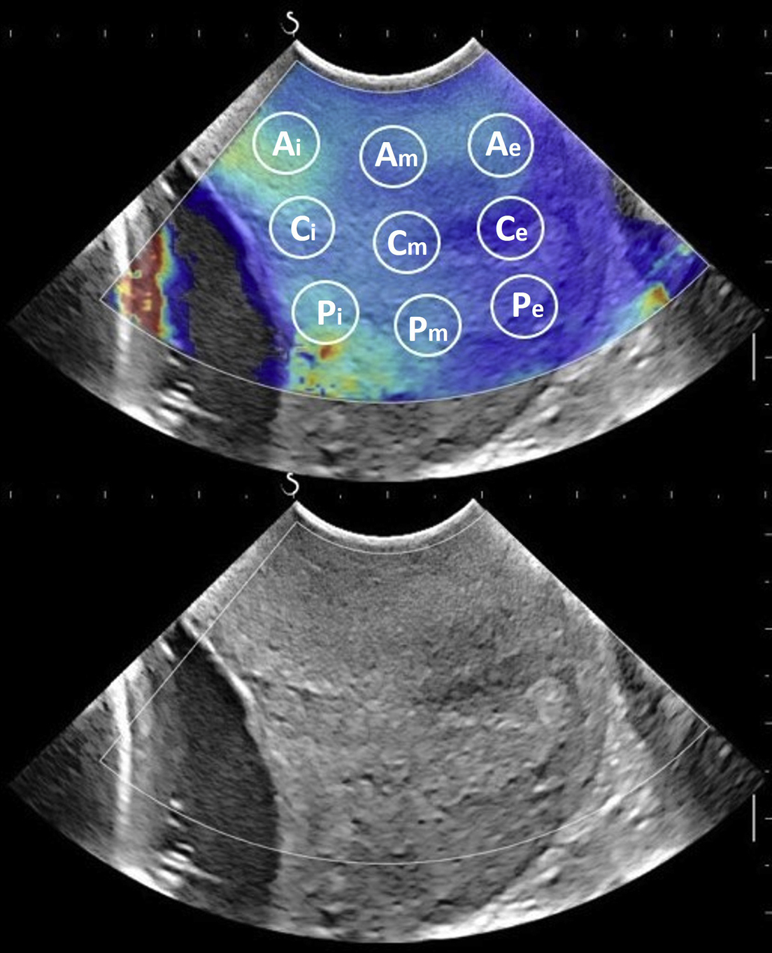 Screening For Spontaneous Preterm Birth By Cervical Length And Shear ...