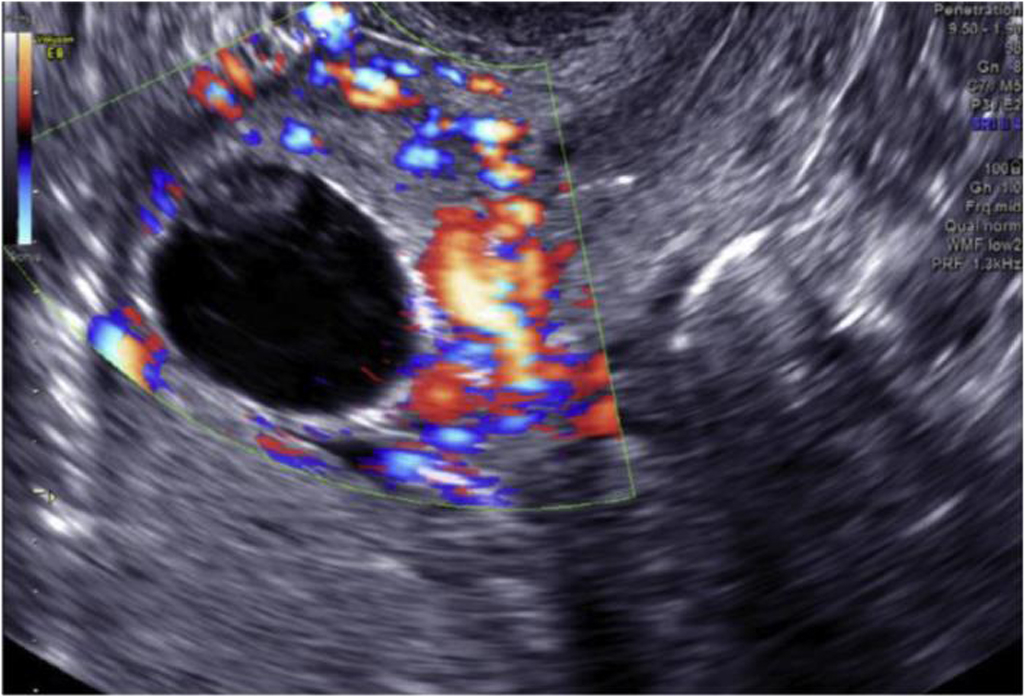 Society For Maternal-Fetal Medicine Consult Series #63: Cesarean Scar ...