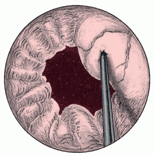 Periurethral And Transurethral Bulking Agents | Obgyn Key