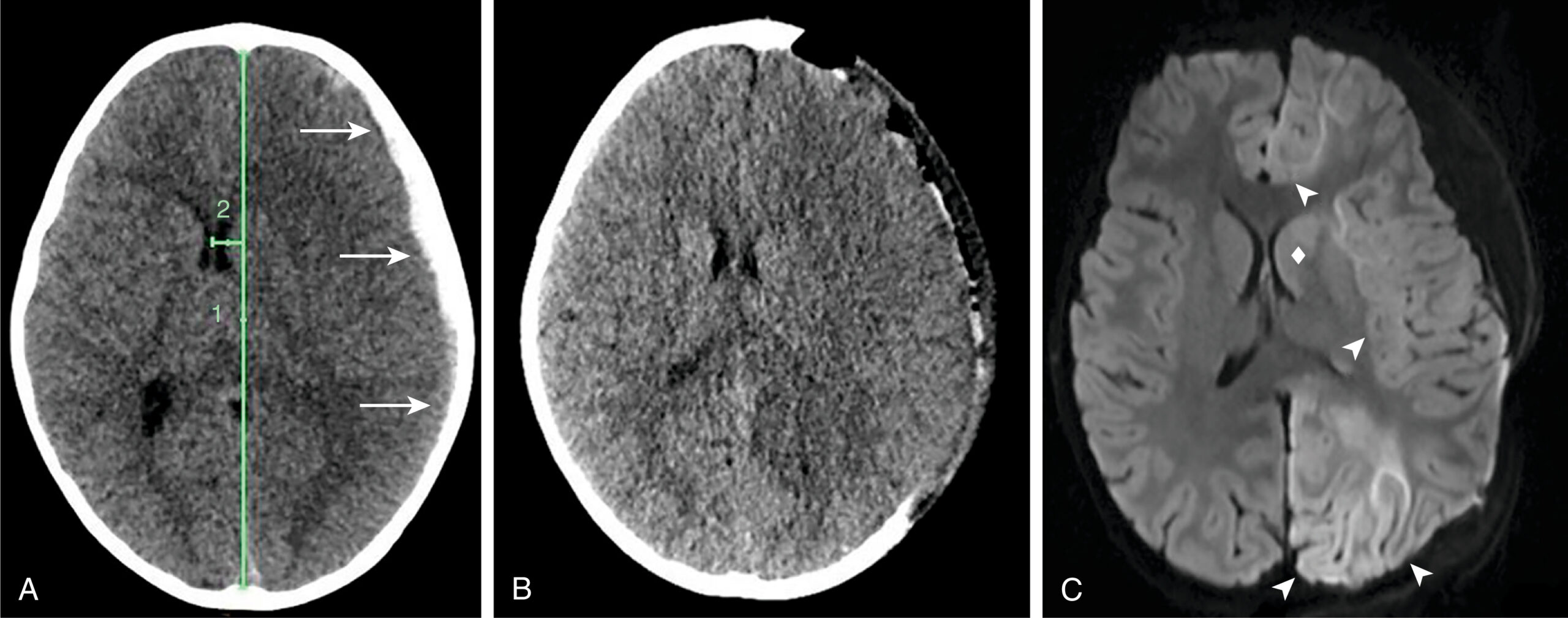 A three-part image shows an axial computed tomographic scan and magnetic resonance imaging of subdural hematoma evacuation, midline shift, and injury to the cortex and basal ganglia. The three-part image, labeled A, B, and C, showing axial computed tomographic scan without contrast, shows a left subdural hematoma before and after surgical evacuation. Panel A shows the hematoma marked by arrows with a midline shift indicated by vertical lines. Panel B shows the same region after surgery, where the hematoma has been cleared and the midline alignment appears restored. Panel C shows axial diffusion-weighted magnetic resonance imaging highlighting additional injury in the underlying cortex marked by arrowheads and involvement of the caudate nucleus of the basal ganglia marked by a diamond.