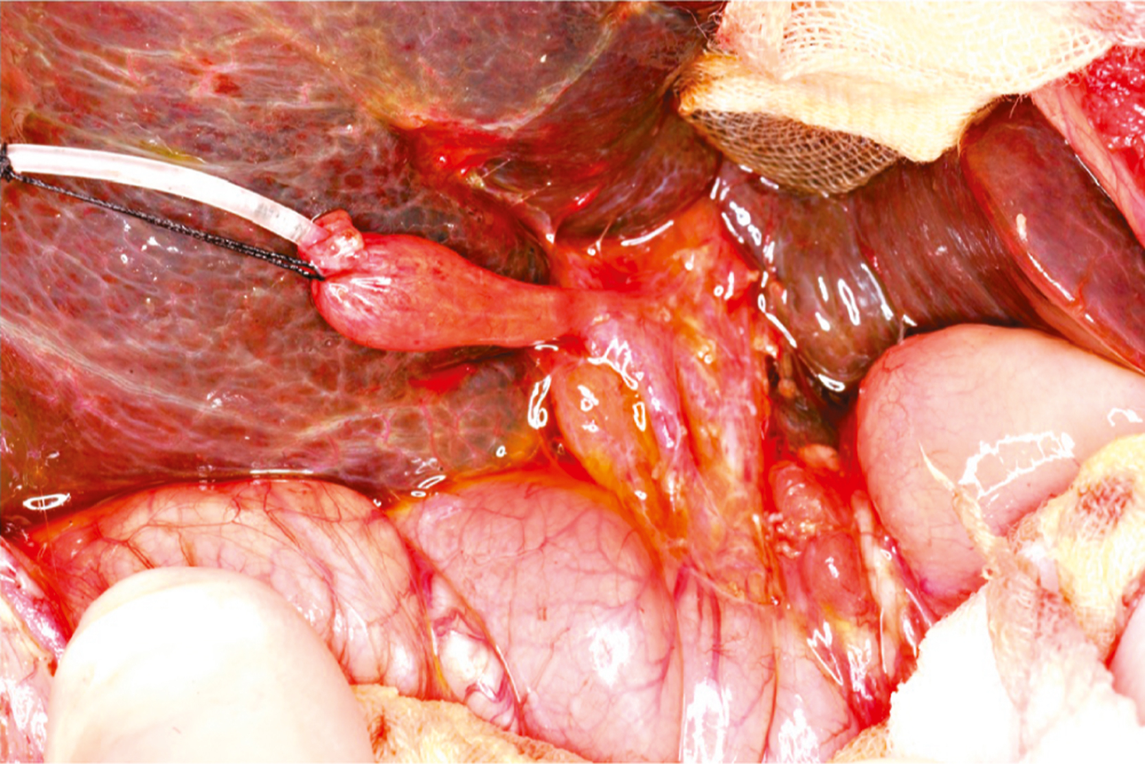 A surgical view shows a tube inserted into a small pouch-like gallbladder. The adjacent liver has an irregular-shaped mass with visible nodules on the surface.