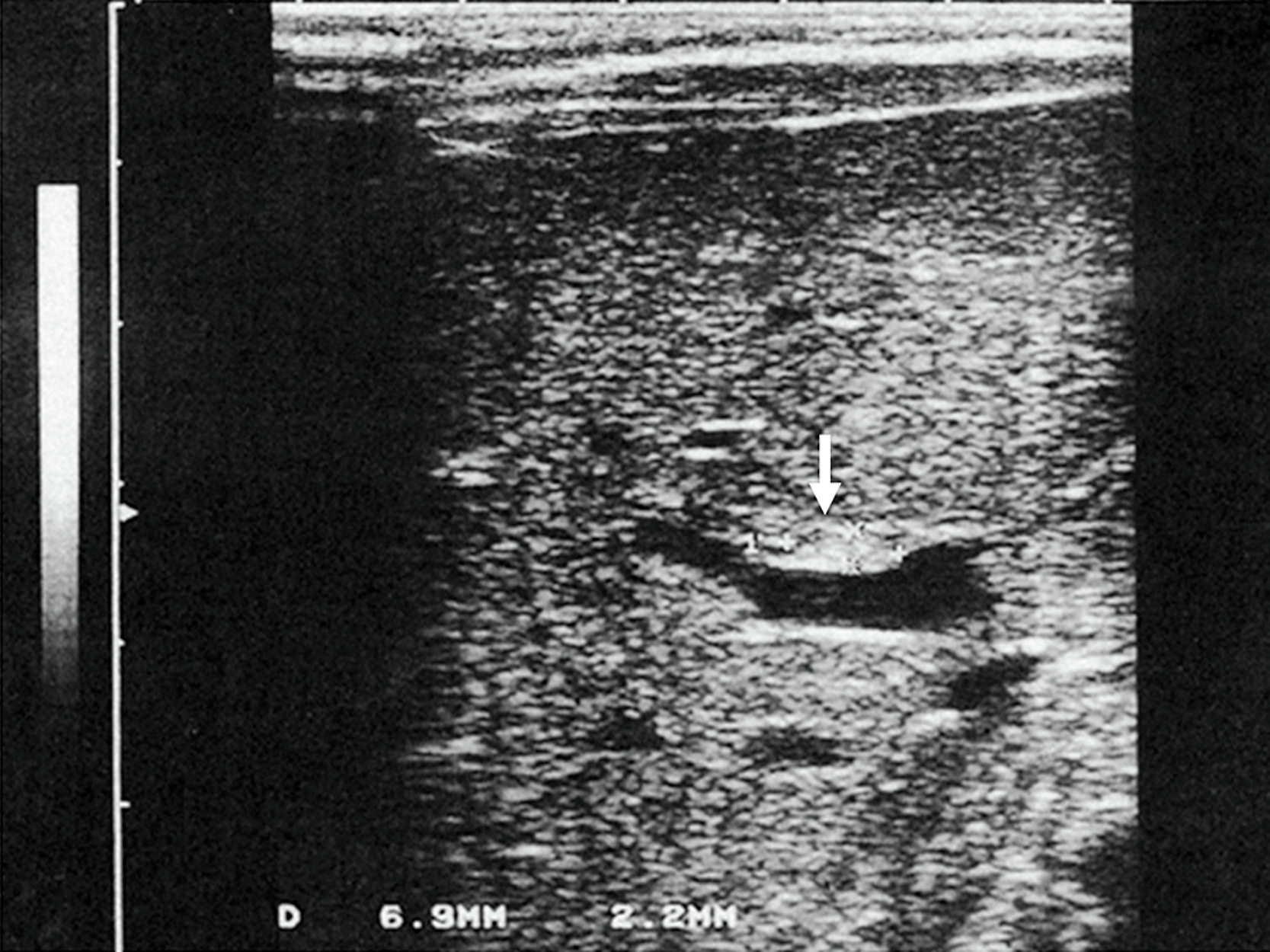 An ultrasound scan shows a small tubular structure with an internal shadow beneath the liver. The ultrasound scan displays a transverse section of the upper abdominal region with grainy echotexture and distinct soft tissue layers. Centrally positioned is a narrow, horizontally oriented tubular structure with defined borders and posterior acoustic shadowing. The echogenic interface and shadow suggest a calculus or dense lesion within a ductal passage. Above the structure lies a slightly hypoechoic area corresponding to hepatic tissue.
