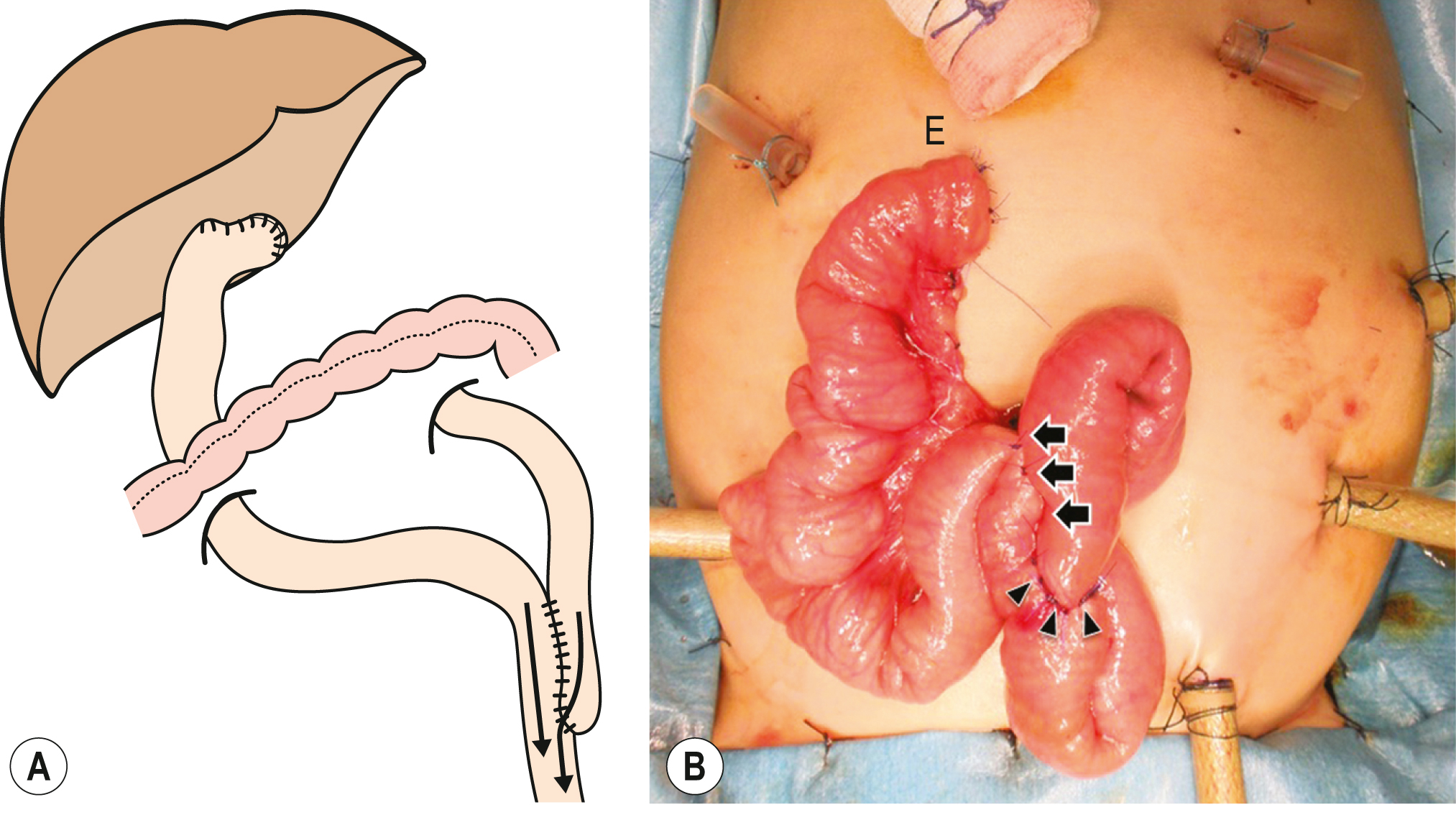 A two-panel illustration shows a surgical diagram and an operative view showing a hepaticojejunostomy with externalized bowel and sutured anastomosis. The two-panel illustration, labeled A and B, shows a conceptual and surgical demonstration of a biliary enteric reconstruction. The left panel, labeled A, shows a simplified anatomical diagram featuring the liver connected to a loop of small intestine. A segment of intestine is drawn with a retrocolic route and a visible anastomotic connection at its distal end. The right panel, labeled B, presents an intraoperative scene with a midline abdominal incision exposing loops of small intestine through a surgical field secured with multiple trocars and retractors. A loop marked by a single letter at the superior position is elevated, and the central portion shows a series of surgical sutures placed along an enteric segment.