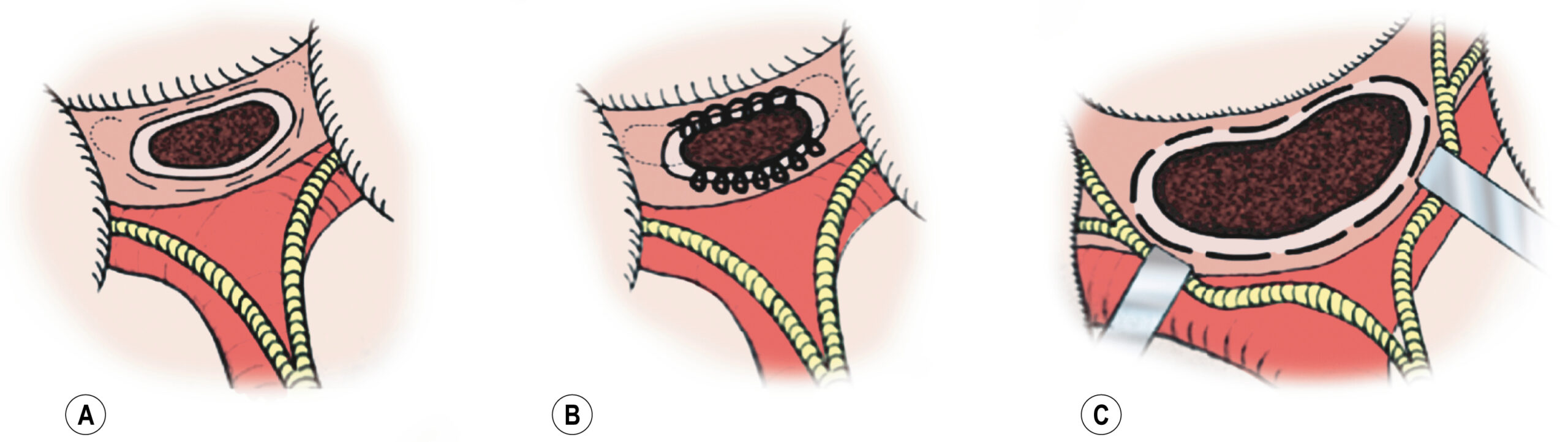 A surgical sequence shows bladder exposure, suture placement, and completed repair across three labeled views. The sequence of three surgical diagrams, labeled A, B, and C, demonstrates steps in a bladder repair procedure. Panel A shows an exposed bladder within a retracted surgical field, with the bladder wall outlined and centrally filled. Surrounding anatomical structures, including muscle and connective tissue planes, are visualized. Panel B illustrates a row of evenly spaced sutures placed across the opened bladder margin. Panel C the bladder fully repaired, with sutures drawn tight along the previous incision line, and surgical retractors placed laterally.