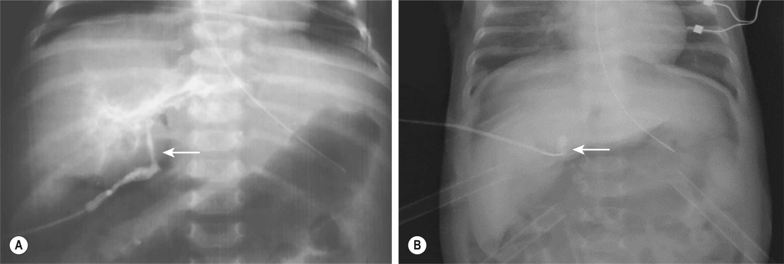 Two radiographic views show contrast-filled tubular structures in the thoracic cavity with a catheter tip visible near the spine. The two radiographic views, labeled A and B, show two separate frontal thoracic scans of the upper abdomen and chest. In panel A, a fine tubular structure filled with contrast material is visible, extending vertically and curving along the midline of the thoracic cavity. A catheter appears in place, with its tip terminating near the lower thoracic spine. In panel B, another catheter is seen coursing through the thoracic field and terminating near the center of the chest, with a localized radiopaque shadow indicating the catheter’s endpoint.