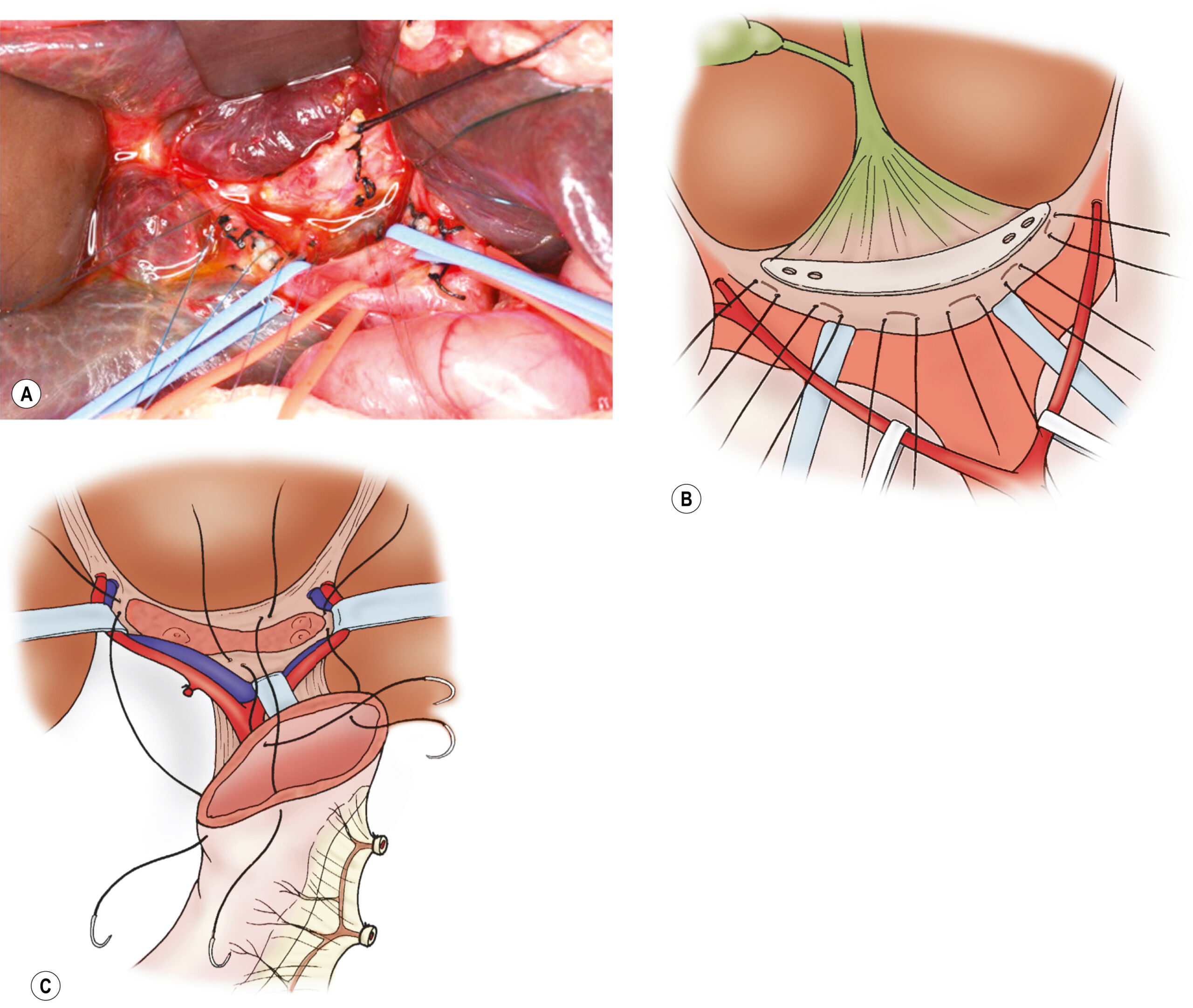 A three-panel illustration shows a surgical view and two schematics of major abdominal vessels and biliary structures with labeled steps of dissection and vascular positioning. The three-panel illustration, labeled A, B, and C, presents a surgical procedure and corresponding labeled anatomical diagrams focused on the abdominal region involving vascular and biliary components. Panel A shows a real intraoperative field with exposed vasculature and bile ducts, where surgical tools and sutures are applied for control and manipulation. The surrounding tissue is retracted, exposing major vessels and ducts near the liver. The gallbladder and bile ducts are encircled with vessel loops. Panel B is a detailed diagram showing layered musculature, vascular pathways, and biliary branching. A fibrous cone is sharply transected at the level of the posterior surface of the portal vein. Panel C shows a Roux-en-Y limb around a transected end, with sutures securing the transected area.