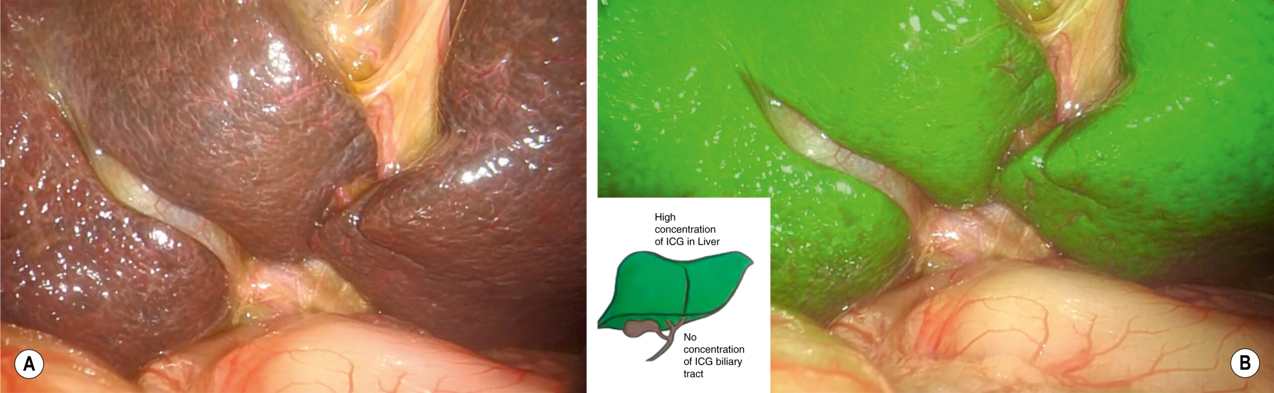 A laparoscopic view shows a liver with segmented lobes and a color overlay highlighting tracer concentration differences across regions. The laparoscopic view shows two adjacent panels, labeled A and B, depicting the liver from an abdominal surgical perspective, with the lobes clearly separated and the biliary tract partially visible. Panel A shows a natural view of the liver with prominent surface texture and anatomical segmentation. Panel B shows the same liver view overlaid with a visual marker, where the upper lobes show strong fluorescence and the lower region remains non fluorescent. An inset in the right panel outlines the interpretation, showing high concentration of tracer in the upper liver and no concentration in the extrahepatic biliary tract.