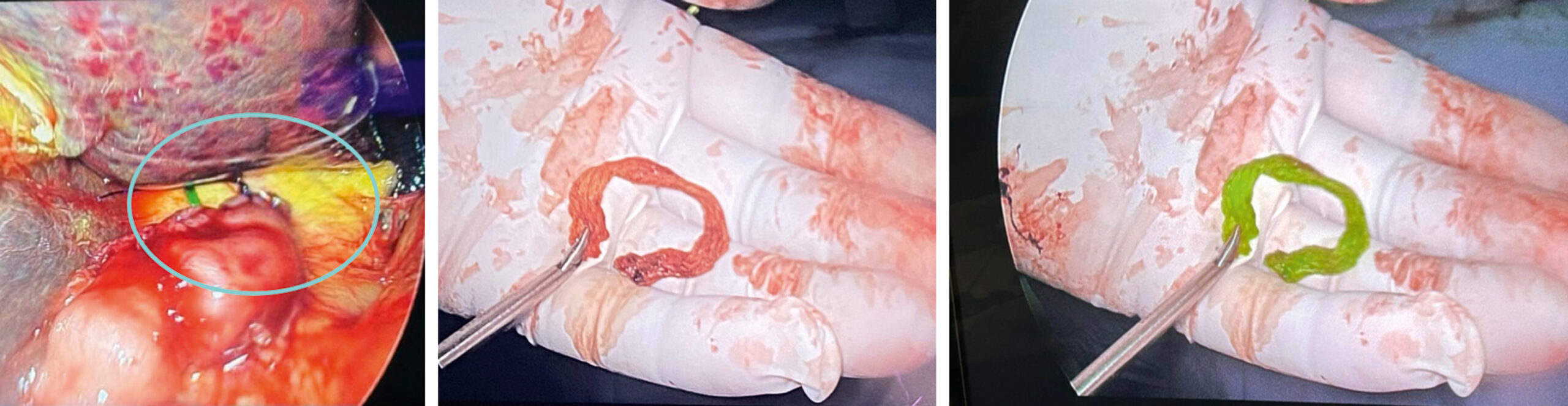 A surgical sequence shows a resected bile duct segment evaluated pre- and post-tracer injection. The surgical sequence shows three panels capturing a bile duct segment before and after tracer evaluation. In the first panel on the left, the bile duct is exposed within the abdominal cavity, encircled for identification, and partially dissected while still connected to surrounding structures. A circular mark highlights the target duct near the liver and bowel. The middle panel shows the removed ductal loop placed on a gloved palm, showing its natural appearance without external enhancement. In the third panel on the right, the same duct segment appears with distinct fluorescent enhancement.
