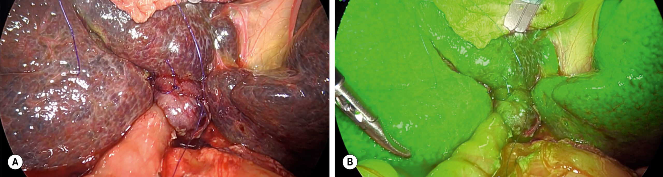 A surgical comparison shows liver and biliary anatomy before and after tracer exposure, highlighting ductal delineation and hepatic surface changes following contrast visualization. The surgical comparison shows two views, labeled A and B, of the hepatic region captured during a hepatobiliary procedure. Panel A presents a native intraoperative view of the liver lobes and biliary structures without tracer enhancement. The liver surface appears coarsely lobulated with visible vasculature and connective tissue borders. Central dissection reveals the convergence zone of bile ducts. Panel B shows the same anatomical region after the introduction of a tracer agent, highlighting the hepatic lobes and biliary branches with clear delineation.