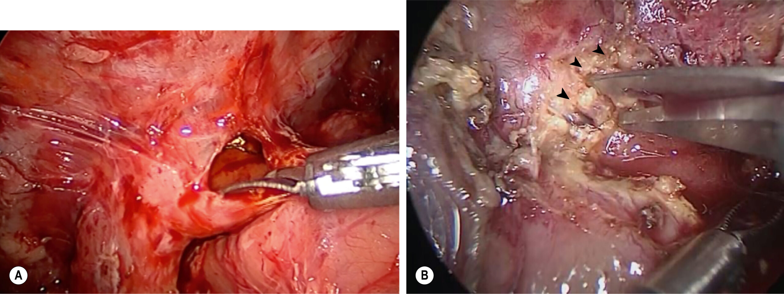 A surgical view shows bile duct exposure with instrument dissection in inflamed tissue, where surrounding structures appear congested and partially separated to reveal ductal anatomy. The surgical view shows two intraoperative scenes, labeled A and B, during a laparoscopic procedure targeting the biliary tract. Panel A displays the careful exposure of the common bile duct, with an instrument inserted into a narrow ductal lumen. The surrounding tissue appears edematous with disrupted peritoneal layers and retracted folds, providing a clear view of the operative field. Panel B captures a different stage in the same procedure, where multiple grasping instruments handle fibrotic and inflamed connective tissue near the hepatic hilum. A small incision, marked by arrows, is visible on the surface.