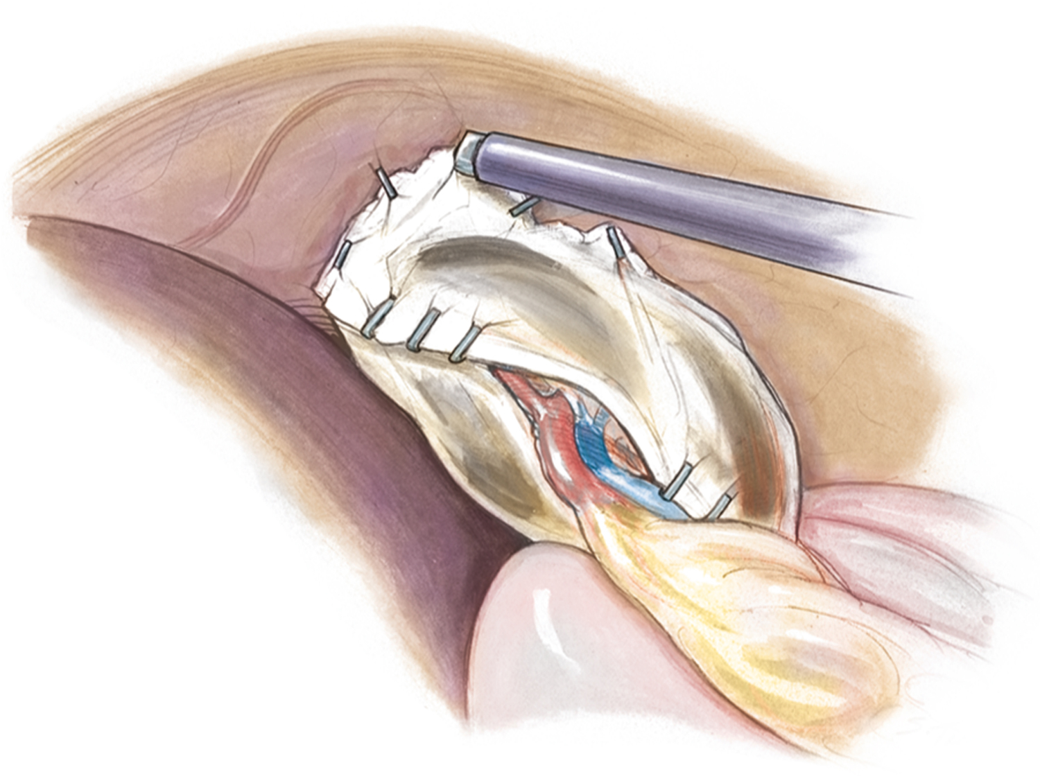 A diagram shows a spleen secured between two sheets of absorbable mesh. Three surgical staple pins are visible in the top left, and two at the bottom