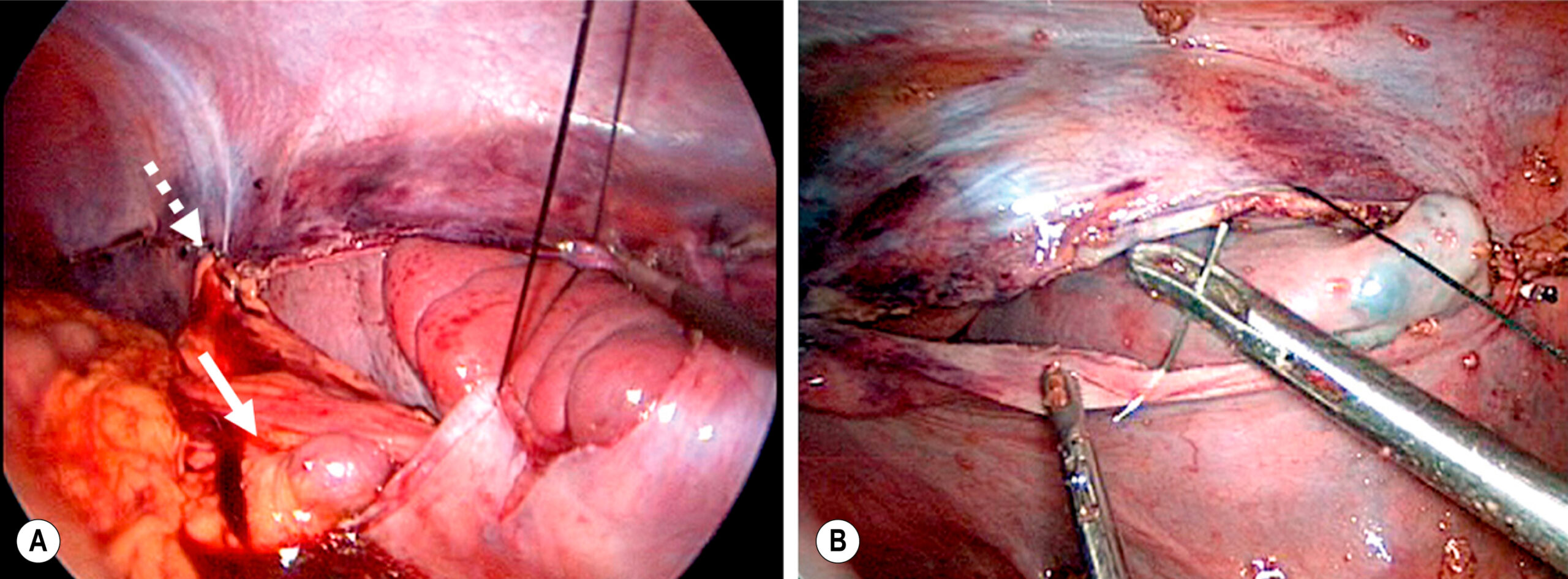 Two laparoscopic views show surgical sutures being placed along the abdominal wall with visible instruments, bowel loops, and surrounding tissue. The two laparoscopic views, labeled A and B, show intra-abdominal surgical steps involving suture placement. The left visual, labeled A, shows a suture being guided along the inner surface of the abdominal wall with a curved segment of bowel visible below. Two sutures, marked by a dotted arrow, are visible along the upper right edge of the spleen. A bubble-shaped splenic vessel is visible at the lower end, marked by a solid arrow. The right visual, labeled B, shows laparoscopic instruments grasping and adjusting a suture line along the abdominal wall while holding nearby tissue. A rounded organ is partially visible beneath the surgical site, and the surrounding peritoneal surface appears reflective and stretched.