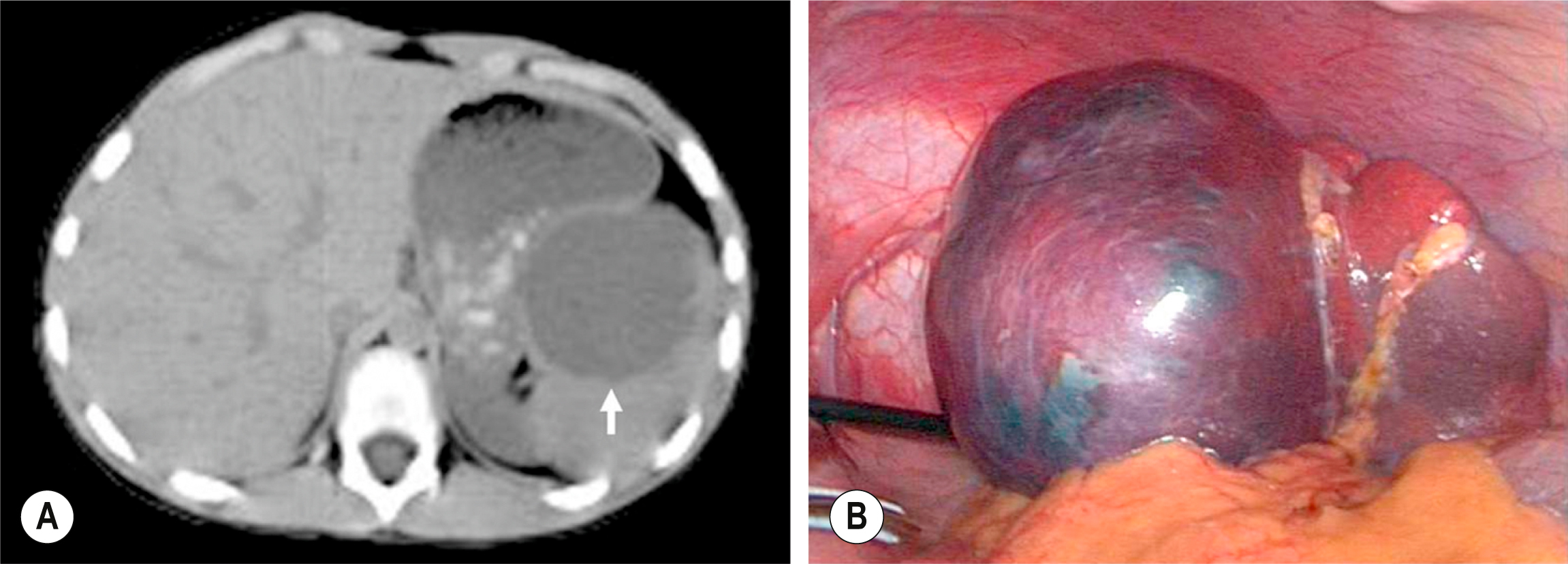 Two abdominal visuals show a cross-sectional scan with a large lesion in the upper abdomen and a laparoscopic view of a similar multilobed mass. The two abdominal visuals, labeled A and B, show a cross-sectional imaging scan and a laparoscopic view of a large abdominal lesion. The left visual, labeled A, is a computed tomography scan showing a rounded lesion occupying the right upper abdominal region with a well-defined margin and displacement of adjacent organs. An arrow points to the lesion boundary. The right visual is a laparoscopic image displaying a large multilobed mass with a tense surface and visible vascular markings. The mass extends across the upper abdominal cavity with surrounding tissue retracted to improve visibility.