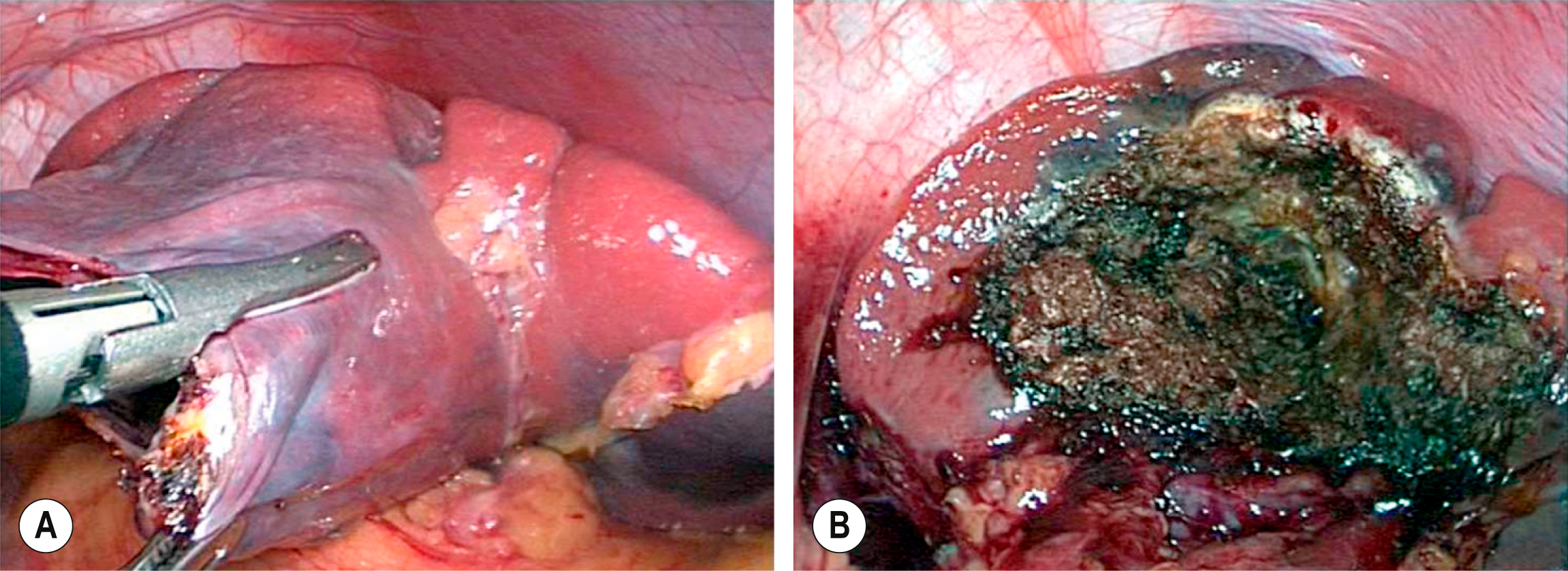Two laparoscopic visuals show the spleen surface before and after thermal injury with instrument contact and a visible darkened tissue area. The two laparoscopic visuals, labeled A and B, show the spleen surface during a surgical procedure. The left visual, labeled A, shows a laparoscopic instrument in contact with the splenic capsule, which appears smooth and intact, with an underlying cyst visible. The right visual, labeled B, shows the excised cyst after thermal injury, with a large darkened area of coagulated and necrotic tissue.